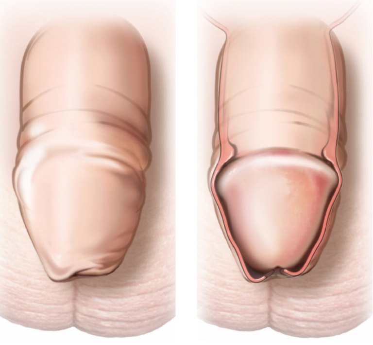 Circumcision & phimosis