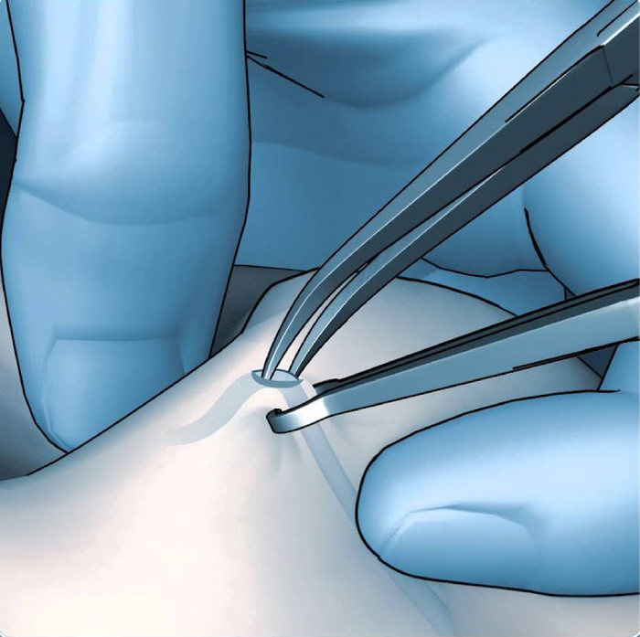 No-scalpel vasectomy
